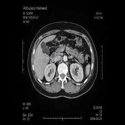 CT Abdomen